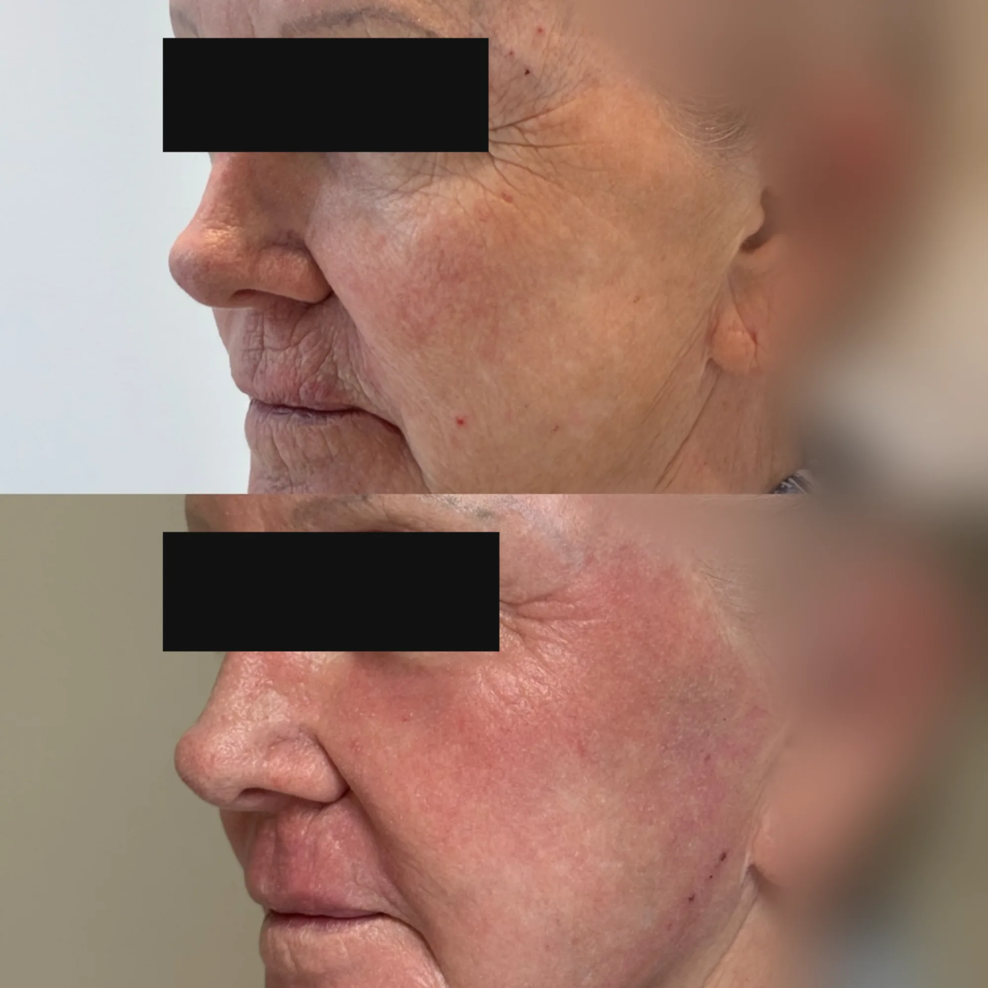 Avant-après anonymisé après une séance de laser CO2 UltraPulse full ablatif du visage, contrôle à trois semaines