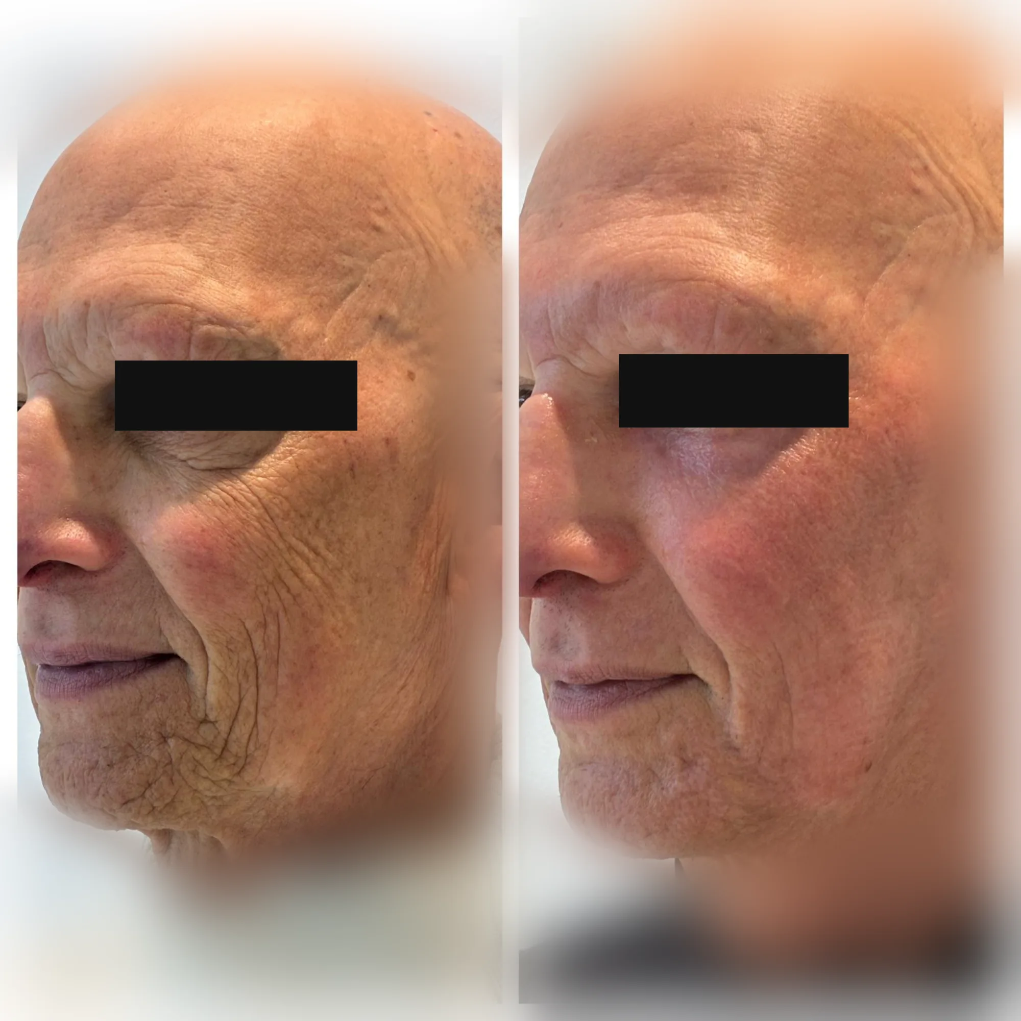 Avant-après anonymisé après une séance de laser CO2 UltraPulse full ablatif du visage, contrôle à un mois — CAS‑001