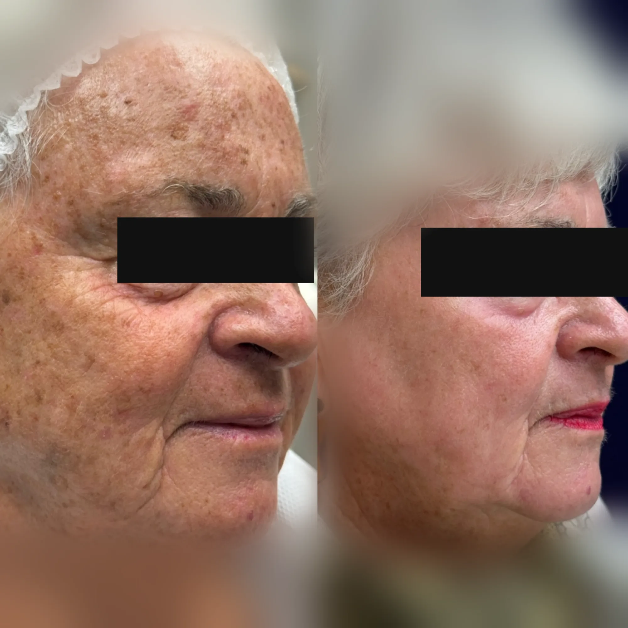 Avant-après anonymisé après une séance de laser CO2 UltraPulse full ablatif du visage, contrôle à un mois — CAS‑002