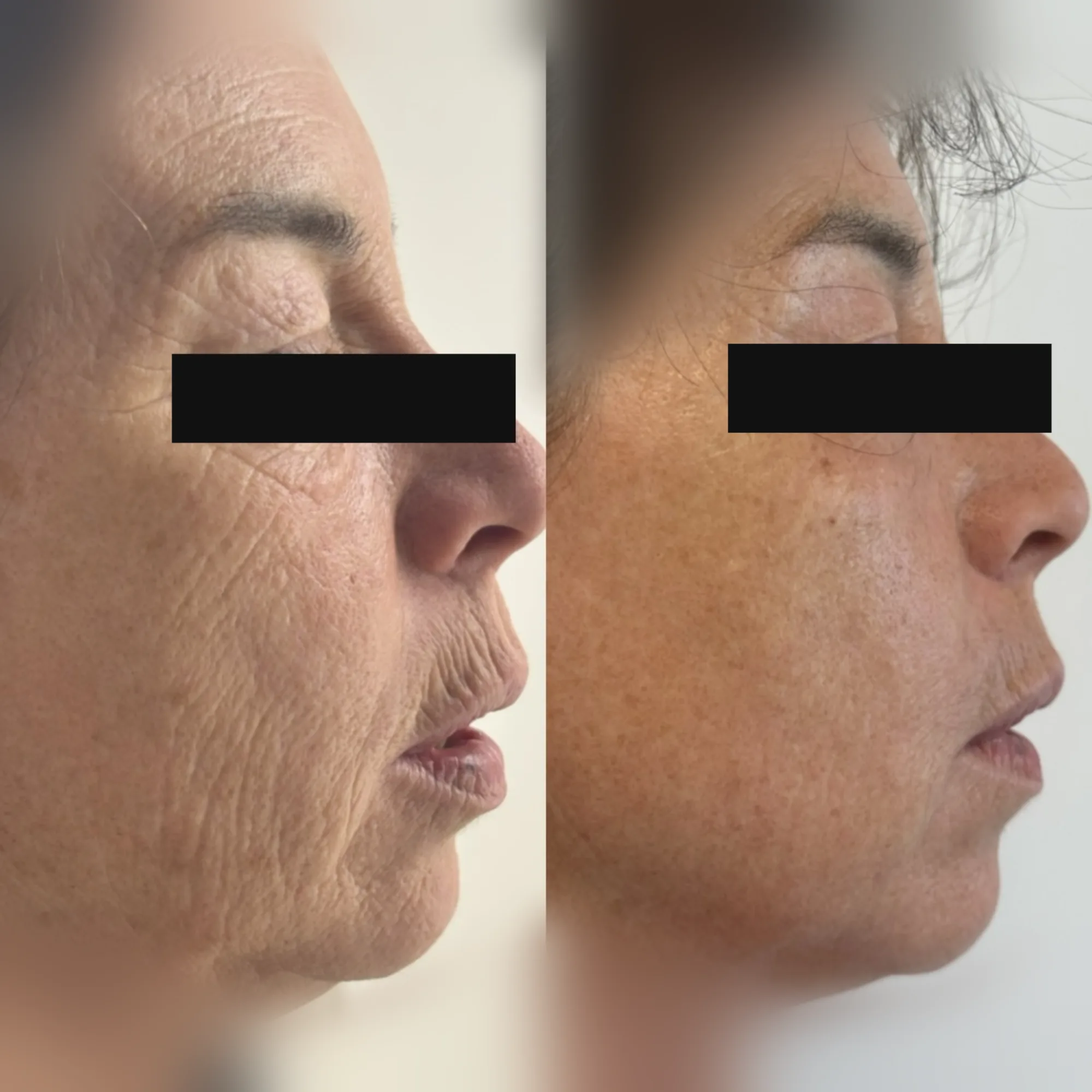 Avant-après anonymisé après une séance de laser CO2 UltraPulse full ablatif du visage, contrôle à trois mois — CAS‑004