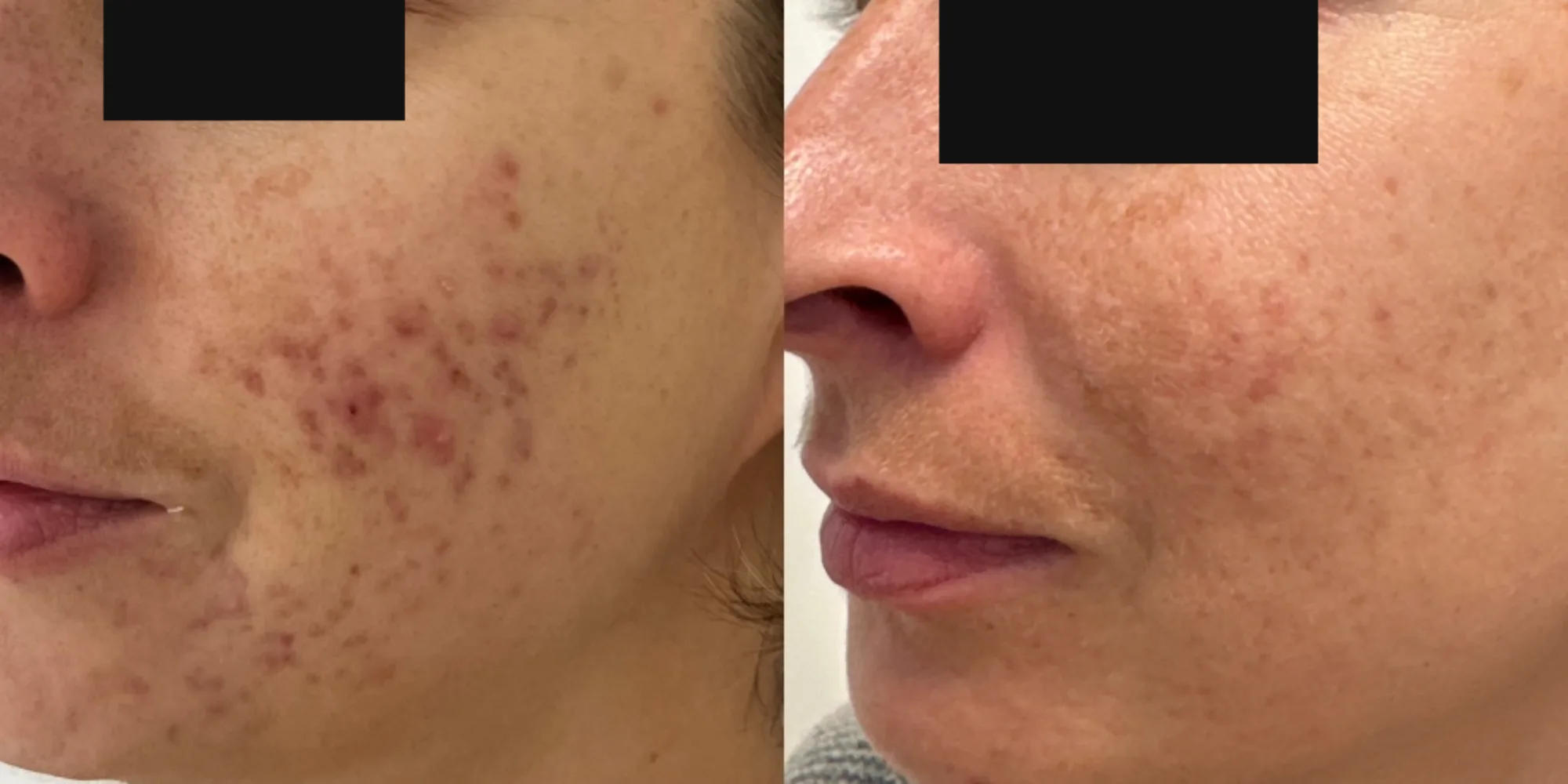 Avant-après anonymisé d’une acné inflammatoire traitée par deux séances associant KTP 532 nm et Genesis Nd:YAG 1064 nm sur ELEMENT‑TL, contrôle à trois mois