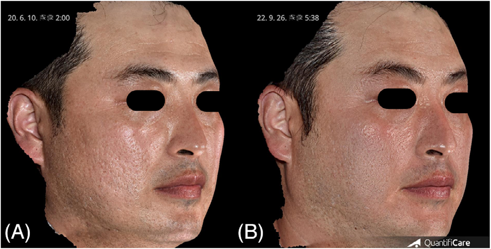Cicatrices faciales atrophiques avant traitement et 22 semaines après cinq séances de Juvelook administré par microjet laser.