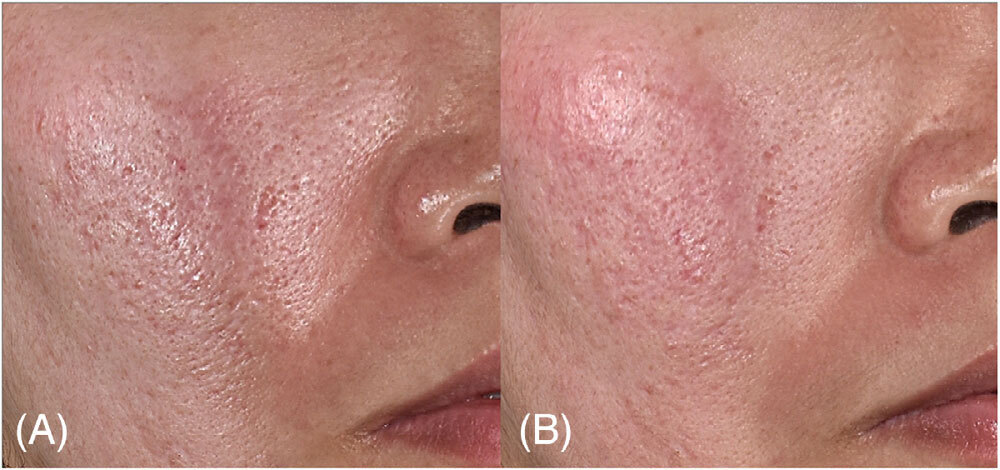 Cicatrices atrophiques de la tempe droite avant traitement et 22 semaines après cinq séances combinant Juvelook et microjet laser.