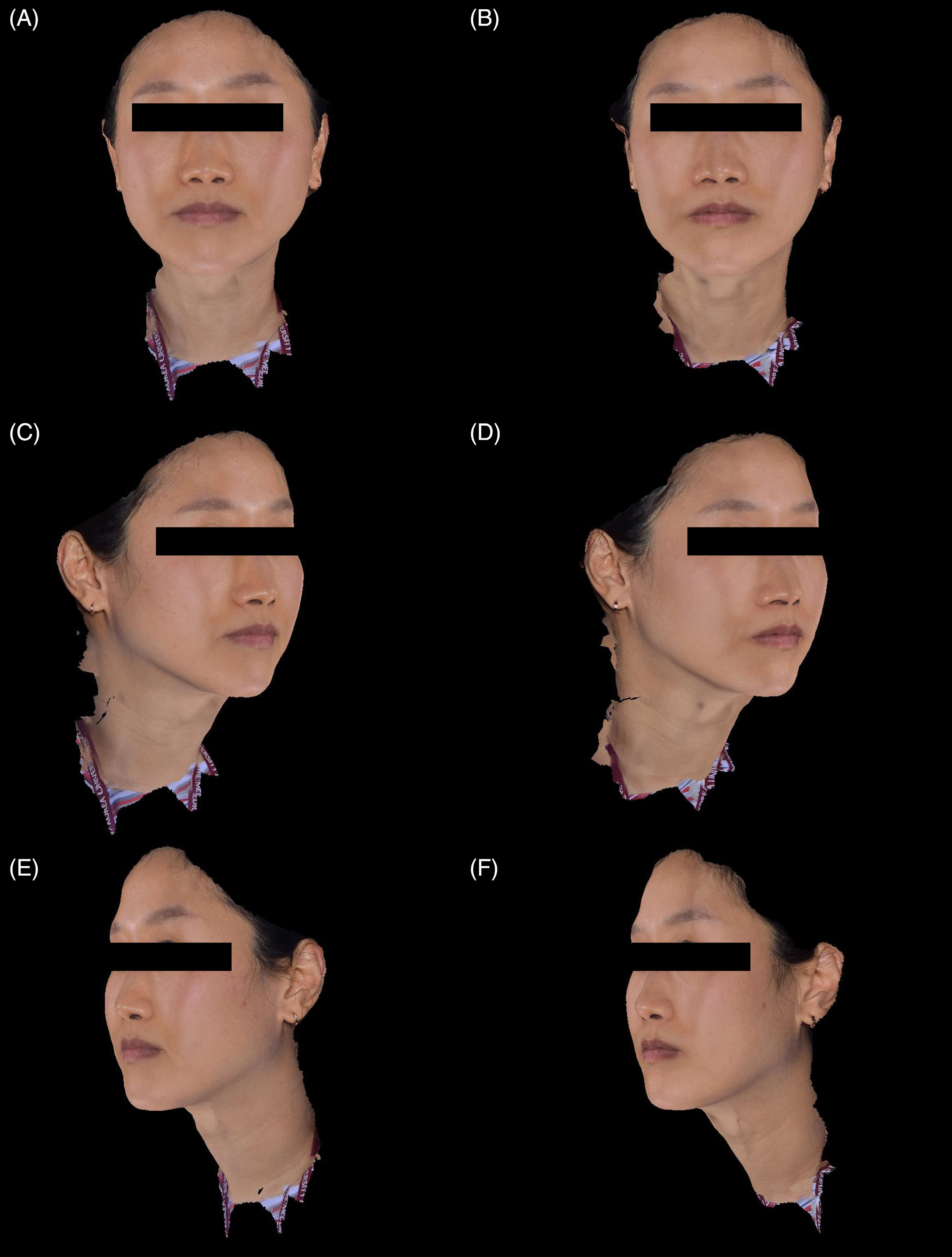 Qualité et texture du visage avant traitement et 16 semaines après deux séances de Juvelook chez une femme de 35 ans.