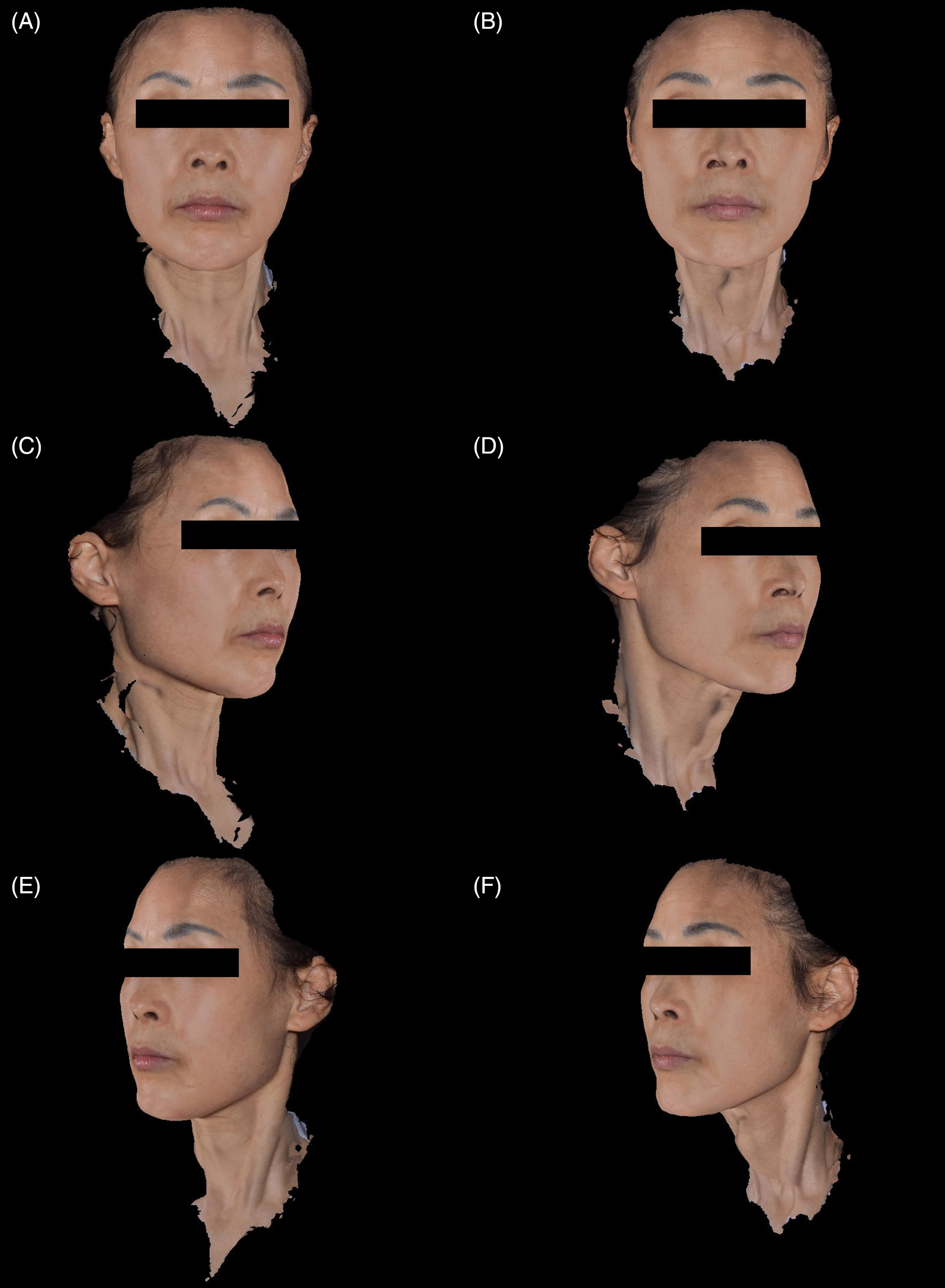 Texture du visage avant traitement et 16 semaines après deux séances de Juvelook chez une femme de 55 ans.