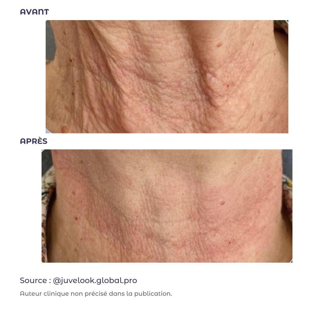 Texture du cou : avant en haut et après en bas, cas externe publié par Juvelook Global Pro