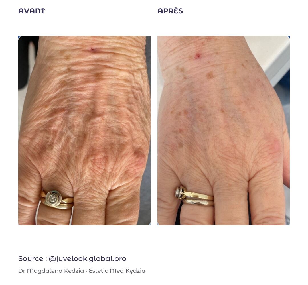 Peau des mains : avant à gauche et après à droite, cas externe publié par Juvelook Global Pro