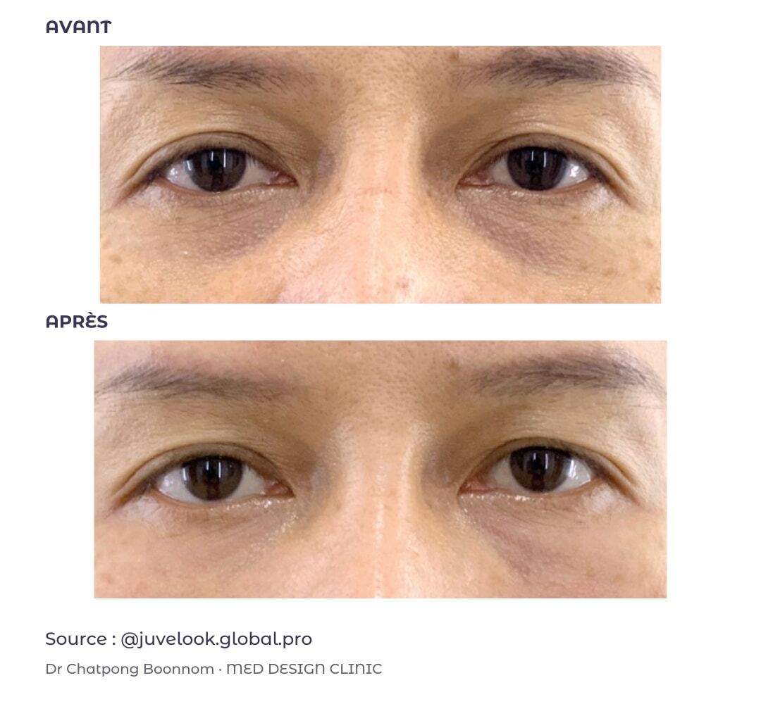 Contour des yeux : avant en haut et après en bas, cas externe publié par Juvelook Global Pro