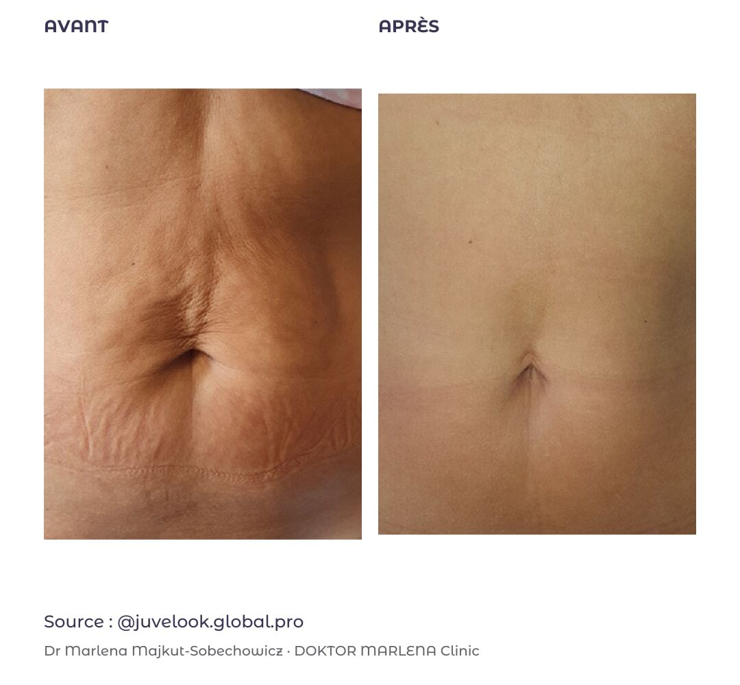 Peau de l’abdomen : avant à gauche et après à droite, cas externe publié par Juvelook Global Pro