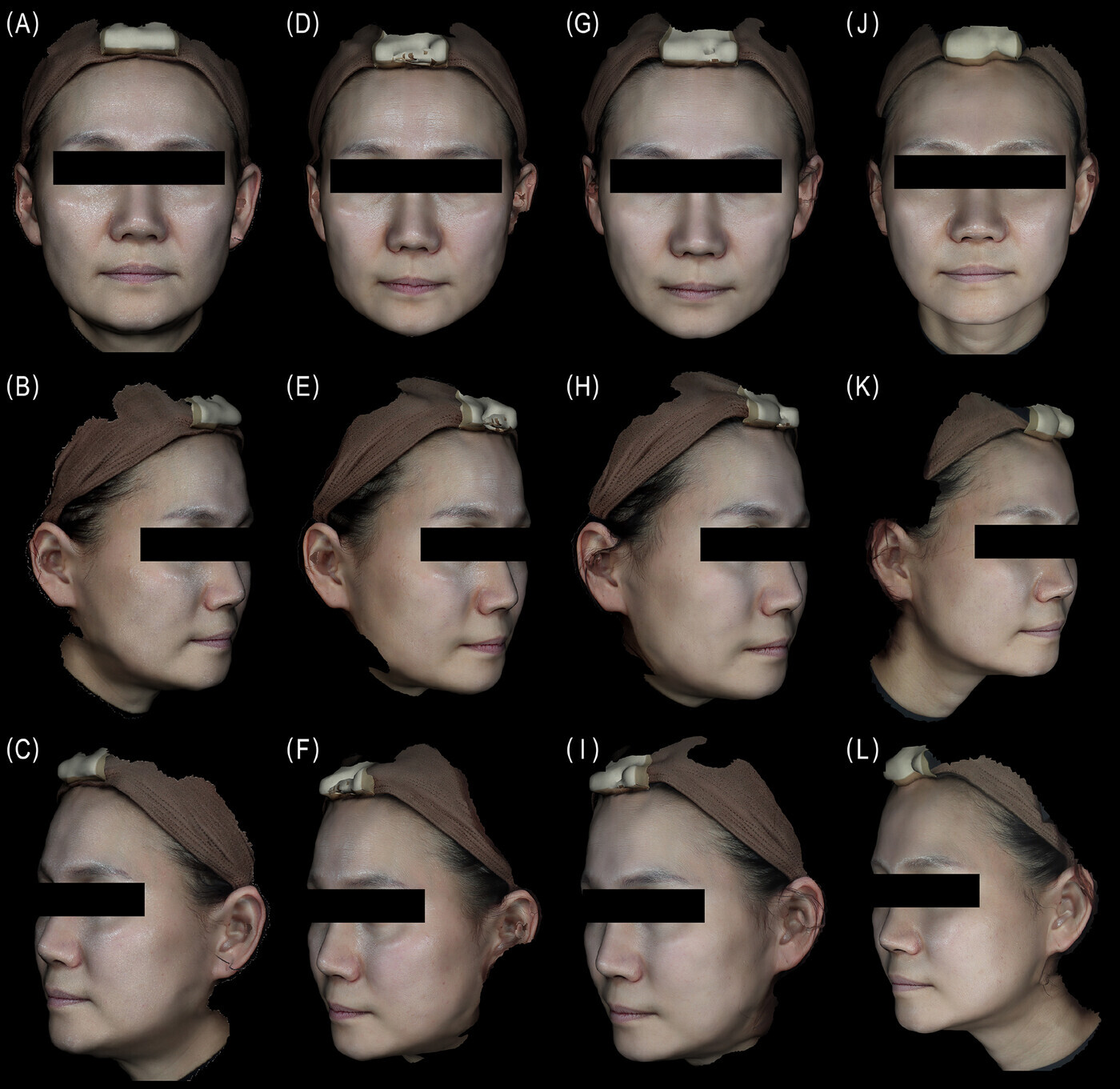 Femme de 48 ans au départ puis aux semaines 4, 8 et 24 dans une étude en visage partagé comparant Lenisna et Sculptra.