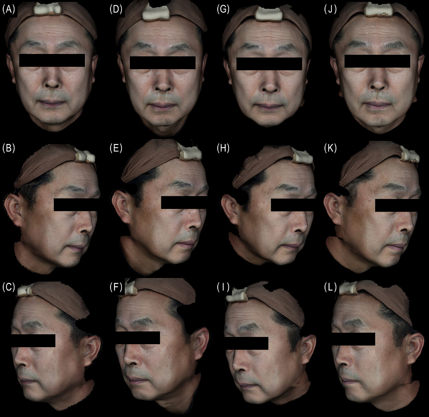 Étude clinique Lenisna et Sculptra : homme de 69 ans, avant traitement puis jusqu’à 24 semaines