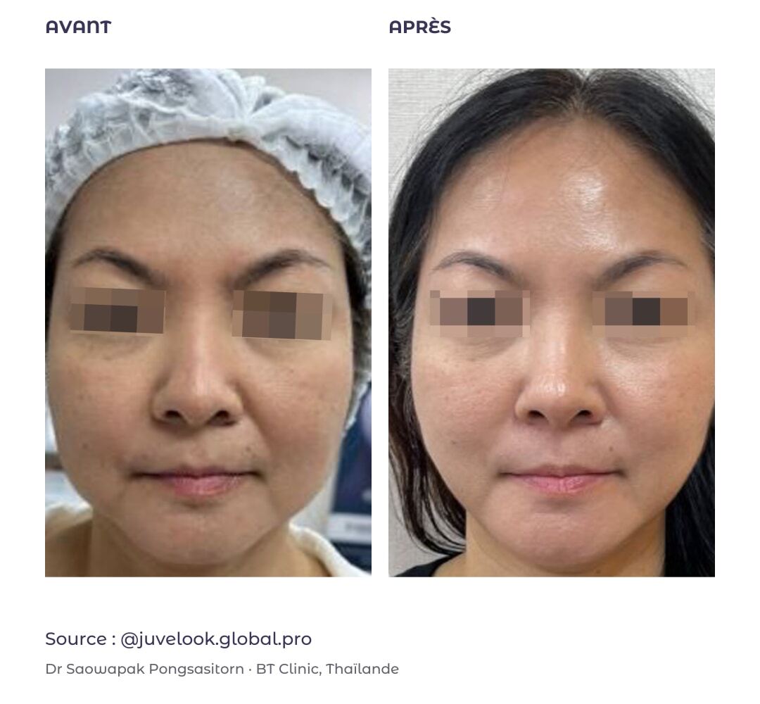 Soutien du visage : avant à gauche et après à droite, cas externe publié par Juvelook Global Pro